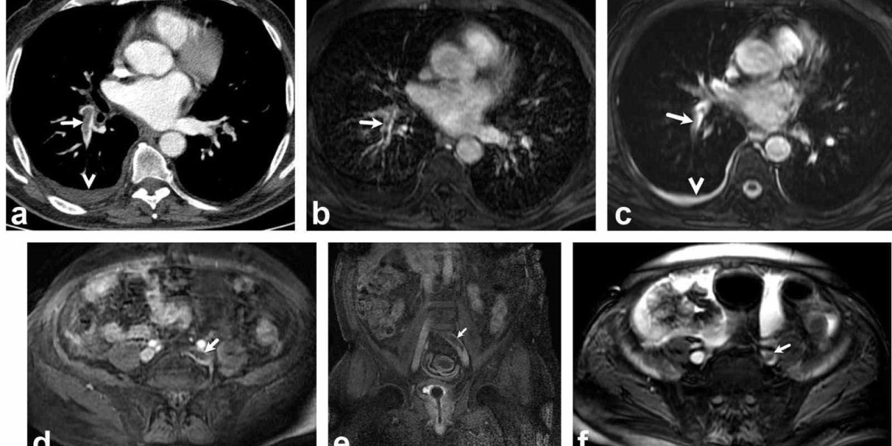 Akciğer damarındaki pıhtıların tanısında radyasyonsuz çözüm