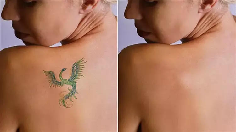 Dövme sildirme işlemi nasıl yapılır ve etkili midir?