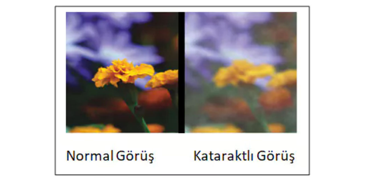 LASIK göz ameliyatı nedir ve nasıl uygulanır?