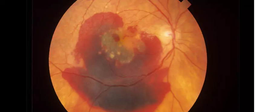 LASIK göz tedavisi ile hangi görme kusurları düzeltilebilir?