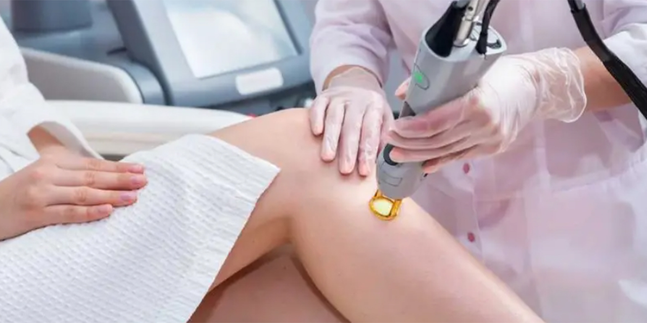 Lazer Epilasyon Nedir?