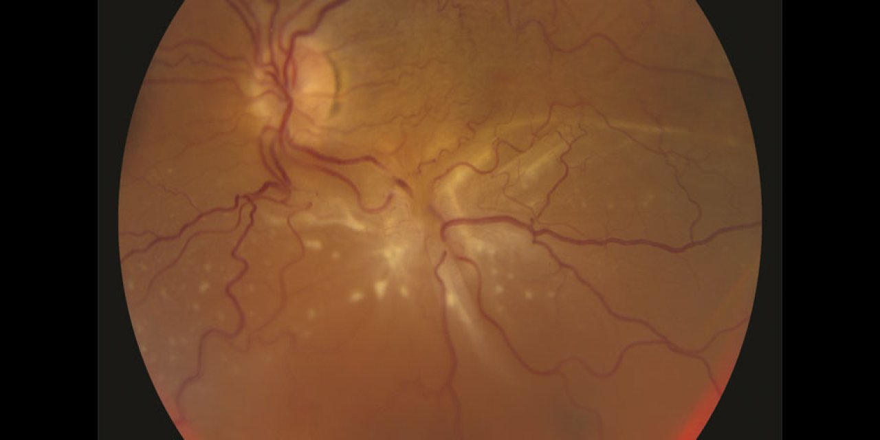 Retina Yırtılması Nedir?