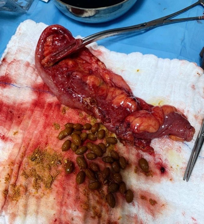 Karnından çıkanlar doktorları bile şaşırttı