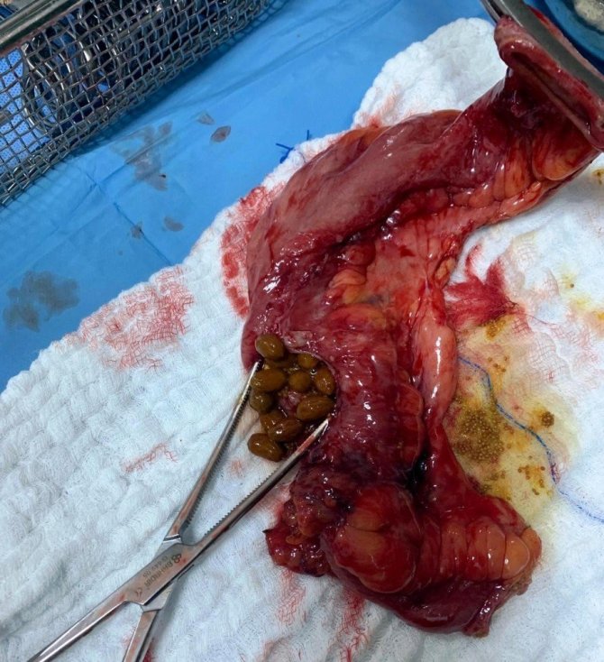 Karnından çıkanlar doktorları bile şaşırttı