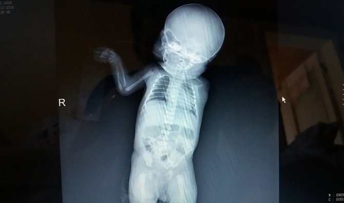 ’Sağlıklı’ dediler, kolsuz doğdu