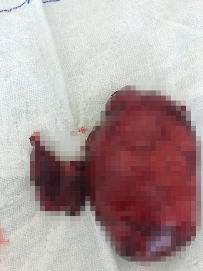 Somalili hastanın boğazından 450 gramlık nodül çıkarıldı